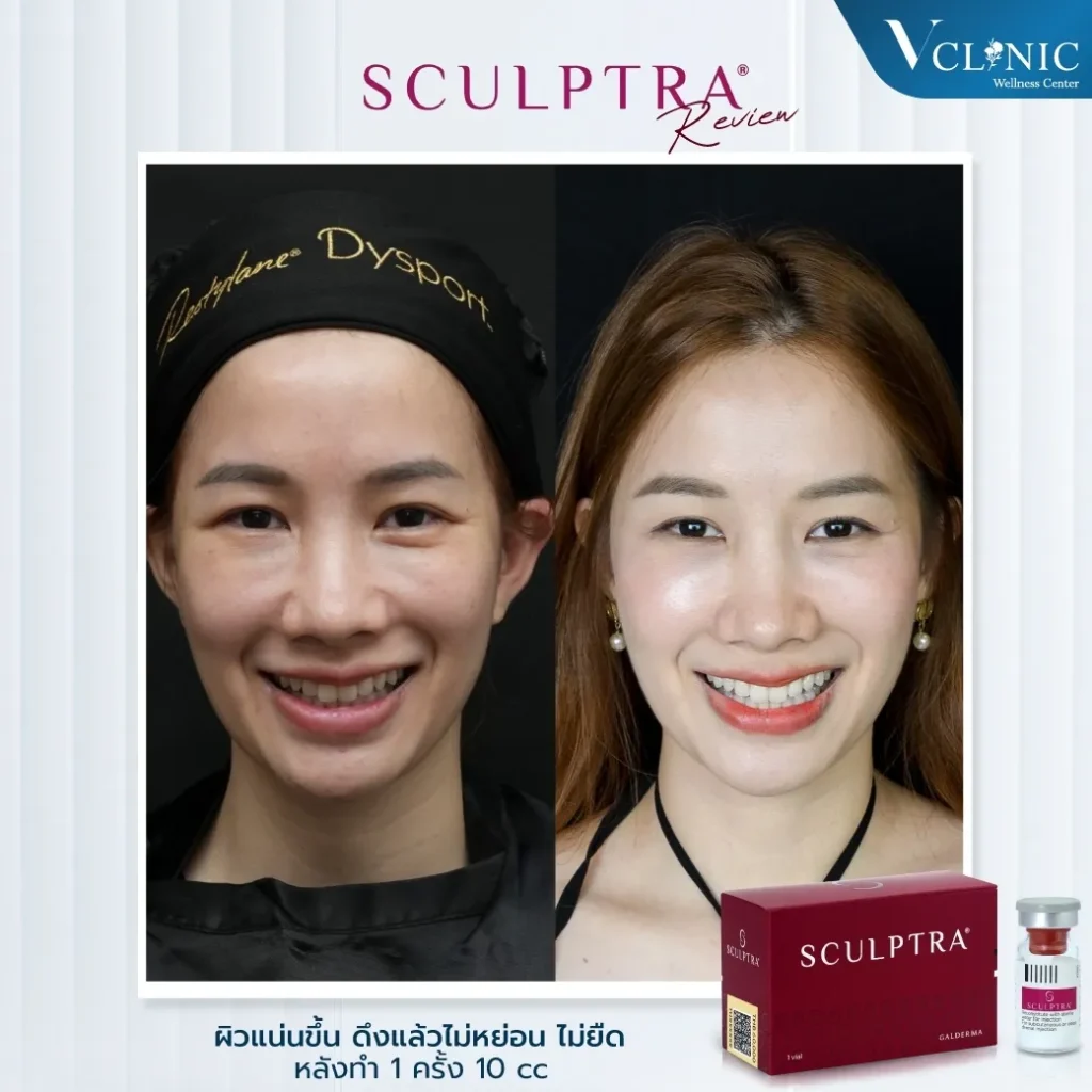 LINEALBUMSculptra๒๓๐๖๒๒0z-z84721609791