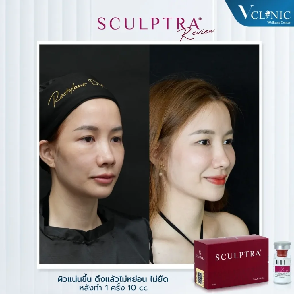 LINEALBUMSculptra๒๓๐๖๒๒3z-z887121060546